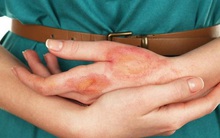 7 dấu hiệu bất thường trên da cho thấy đường huyết đang tăng cao, hãy can thiệp khẩn cấp để tránh các biến chứng nguy hiểm