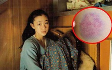 5 dấu hiệu được "khắc" rất rõ trên da cảnh báo nguy cơ mắc bệnh tim, bất kì ai cũng bị nhầm lẫn với dị ứng