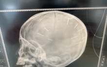 BV Xanh Pôn cập nhật mới nhất về sức khoẻ bé gái có 9 vật giống đinh trong đầu