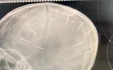 Công an triệu tập mẹ bé gái 3 tuổi có 9 vật thể giống đinh trong sọ não