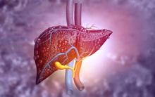 4 thói quen khiến gan "nát như đậu phụ", điều số 4 rất nhiều người khó thay đổi nên cứ 10 người thì có đến 3, 4 người bị gan nhiễm mỡ