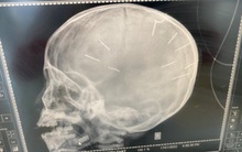 Sức khoẻ của bé 3 tuổi bị người tình của mẹ đóng đinh vào đầu hiện ra sao?