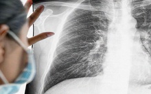 Tưởng rằng chỉ hút thuốc mới bị ung thư phổi, 5 lý do này cũng khiến người bình thường mắc phải căn bệnh quái ác