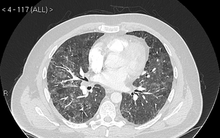 Người đàn ông bị viêm phổi nặng, khó thở trong thời gian dài vì 1 đồ vật mà chúng ta ''đầu ấp tay gối'' hàng ngày