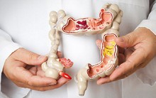 Người đàn ông bị đau bụng âm ỉ kèm táo bón, đi khám bất ngờ phát hiện ung thư đường tiêu hóa