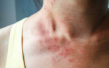 Cô gái 21 tuổi suýt tử vong chỉ sau vài giờ phát ban khắp cơ thể