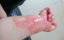 Bé trai bị bỏng nước sôi 100 độ, cách sơ cứu của bà mẹ được bác sĩ tấm tắc khen ngợi, ai cũng nên học hỏi