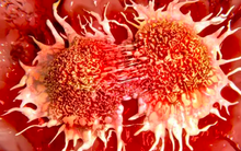 3 loại "ung thư hôn nhân": Khi một người mắc thì nửa kia cần được tầm soát càng sớm càng tốt