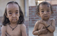 Cuộc sống của hai đứa trẻ sinh ra với gương mặt già nua hơn cả bố mẹ