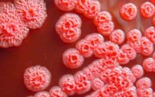 Những biểu hiện lâm sàng thường gặp của bệnh Whitmore