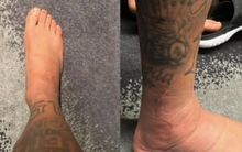 Cận cảnh bàn chân sưng vù của Neymar khiến CĐV Brazil đứng ngồi không yên