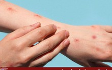 Virus đậu mùa khỉ lây truyền 4 ngày trước khi các triệu chứng bệnh xuất hiện