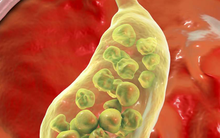 Chỉ đau lưng, người phụ nữ bất ngờ khi đi khám bác sĩ gắp ra 382 viên sỏi