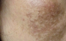 Phát hiện mẫu kem trị nám có hàm lượng thủy ngân vượt mức