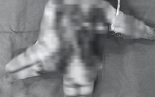 Thiếu niên 14 tuổi nát bàn tay do nổ điện thoại