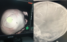 Vụ bé 3 tuổi bị nhân tình của mẹ đóng đinh ở đầu: Đáp ứng điều trị kém, tiên lượng dè dặt