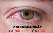 2 nơi ngứa ngáy là "kíp nổ" của gan: Tuân thủ 3 điều kiêng, 1 việc siêng mỗi ngày để bổ gan giải độc, dưỡng sinh khí