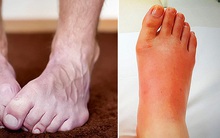 4 biểu hiện ở bàn chân cho thấy bạn cần đến gặp bác sĩ càng sớm càng tốt