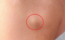 Nhìn bằng mắt thường cũng thấy 3 triệu chứng lạ này thì đừng chủ quan, rất có thể bạn đã mắc ung thư