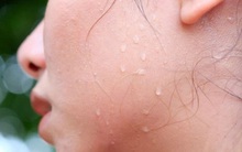 Gan nhiễm độc nặng thường xuất hiện 6 dấu hiệu cảnh báo, chỉ có một vài dấu hiệu cũng nên thải độc gan gấp để tránh da xấu xí