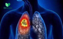 4 thứ quen thuộc trong sinh hoạt khiến gia đình 3 người lần lượt mắc ung thư phổi: Điều thứ 2 nhiều nhà khó tránh!