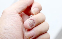 Gan không tốt, trên tay sẽ phát ra 4 tín hiệu, nếu không có, gan của bạn vẫn rất khỏe mạnh