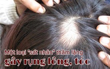 "Lông" rụng ở chỗ này cảnh báo một loại "SÁT NHÂN" thầm lặng: Căn bệnh nan y ít người biết đến, có những dấu hiệu này phải đi khám ngay