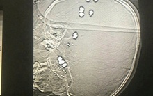 Bé trai 6 tuổi bị 11 viên đạn bi găm vào đầu