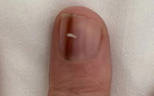Đi khám vì dấu vết lạ trên móng tay, người phụ nữ sốc khi phát hiện 'thủ phạm' đáng sợ