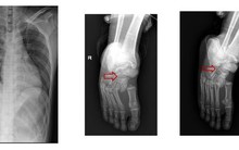 TP HCM: Thang máy rơi, hai người bị liệt 2 chân