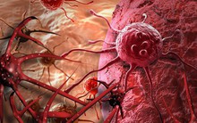 Tế bào ung thư mạnh hơn tế bào thường: 5 sai lầm có thể ảnh hưởng tính mạng người bệnh