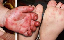 TP. Hồ Chí Minh: Số ca mắc tay chân miệng, sốt xuất huyết tiếp tục gia tăng