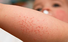 Khi bị sốt xuất huyết cần ghi nhớ 5 lưu ý "vàng" để nhanh hồi phục