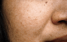 3 tín hiệu "không đau, không ngứa" trên khuôn mặt ngầm cho thấy gan đang bị tổn thương