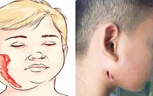 BS Trương Hữu Khanh nói về căn bệnh bị gọi tên 'vi khuẩn ăn thịt người'