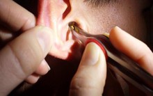 Những cách lấy ráy tai sai lầm có thể khiến bạn điếc vĩnh viễn