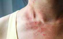 Người có lá gan kém sẽ có 2 biểu hiện này ở cổ: Hy vọng bạn không gặp phải điều nào