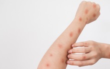 Châu Á báo động cao về dịch đậu mùa khỉ, WHO nhắc nhở: "Chúng ta cần cảnh giác"