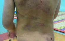 Bé gái mang đầy vết thương gây dậy sóng mạng xã hội ở cùng mẹ và cha dượng