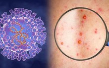 Mới: Ba tình huống bệnh đậu mùa khỉ xuất hiện tại Việt Nam