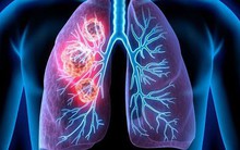 2 vợ chồng cùng mắc ung thư phổi: Bác sĩ chỉ ra nguyên nhân