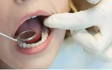 Dấu hiệu này trên miệng cảnh báo thiếu hụt vitamin và các bệnh khác