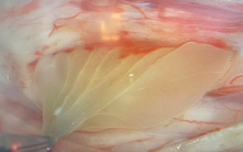 Hay ăn đồ sống, gỏi, người đàn ông bị liệt gần như hoàn toàn 2 chân vì... nang sán nội tủy