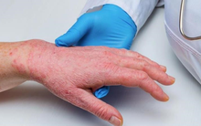 Mỹ ban bố tình trạng khẩn cấp toàn quốc vì bệnh đậu mùa khỉ