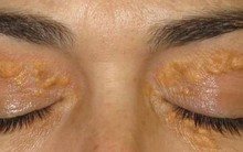 Khi bệnh tim “tấn công”, trên cơ thể sẽ có 3 phản ứng kỳ lạ