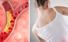 Đau ở 3 vùng này có thể là dấu hiệu của cholesterol cao