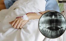 Nam sinh 16 tuổi bị viêm lợi cấp, vào viện mới phát hiện mắc ung thư máu