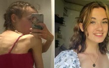 Chỉ vì giảm cân, cô gái trẻ ngoài 20 tuổi không ngờ cột sống của mình như người 80 tuổi