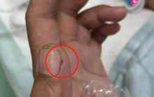 Bị viêm màng não nguy kịch vì cách sơ chế thịt lợn sai nhiều người mắc