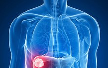 Thống kê mới nhất: Hơn 26 nghìn người mắc mỗi năm, đây là ung thư gây tử vong nhiều nhất, 77% ở nam giới